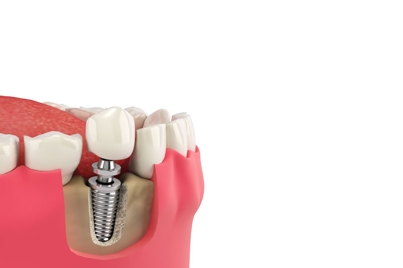 a cutaway of the gums with a dental implant being shown and a crown on top