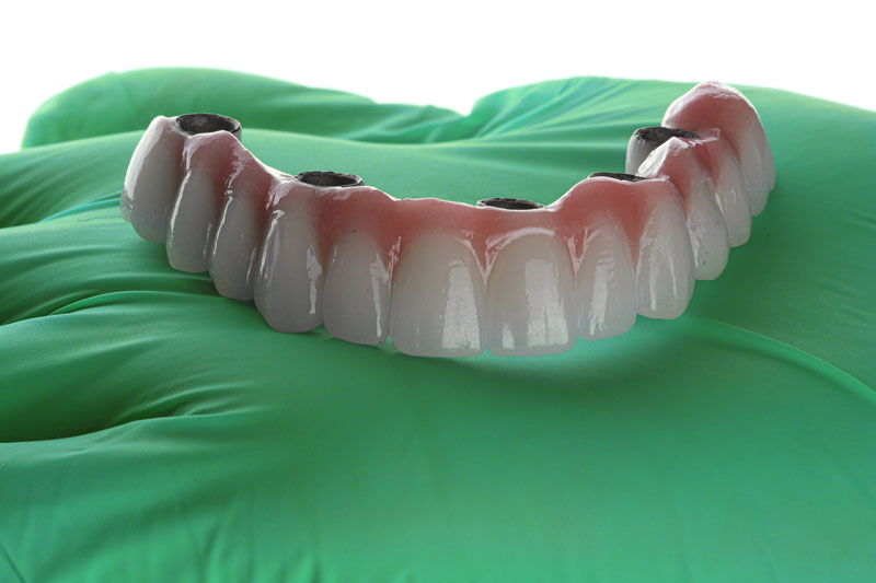 a full arch of teeth with 4 holes for dental implants to be placed into the jaw
